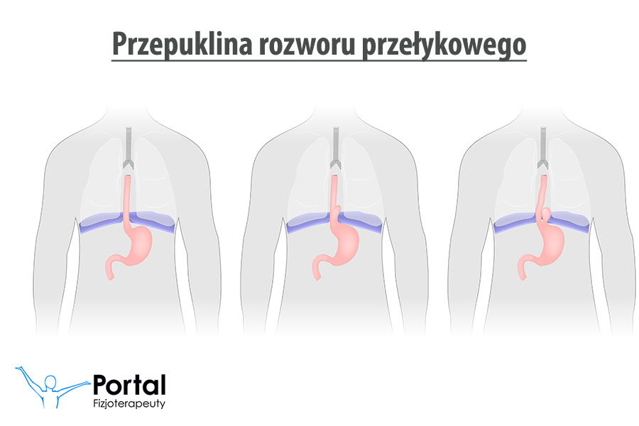 Przepuklina rozworu przełykowego