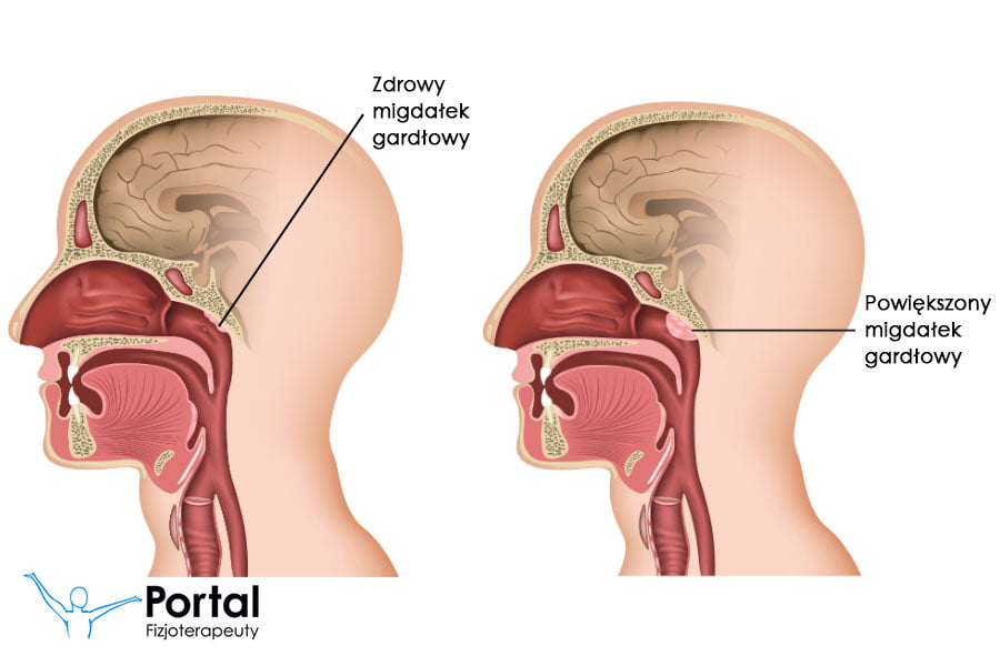 Powiększone migdały