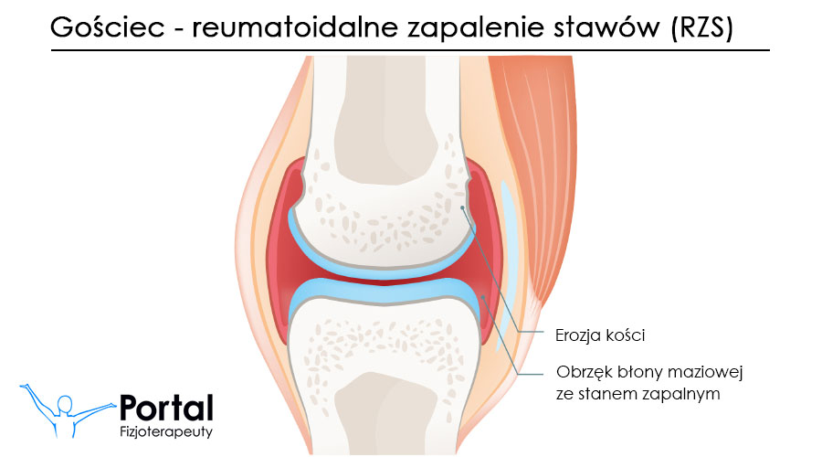 Gościec - reumatoidalne zapalenie stawów (RZS)