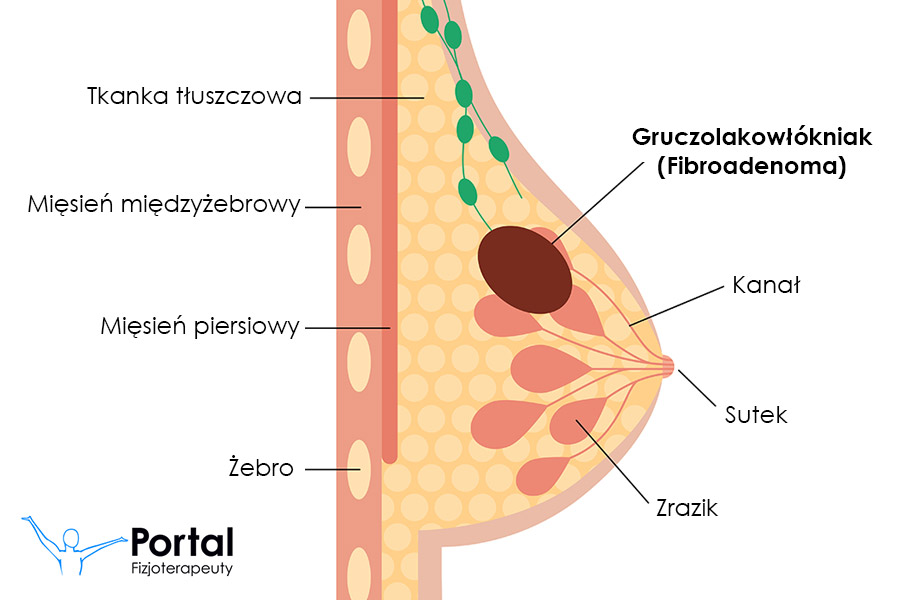 Fibroadenoma