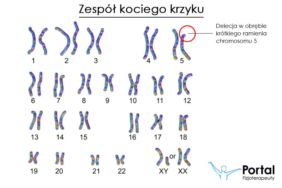 Zespół kociego krzyku