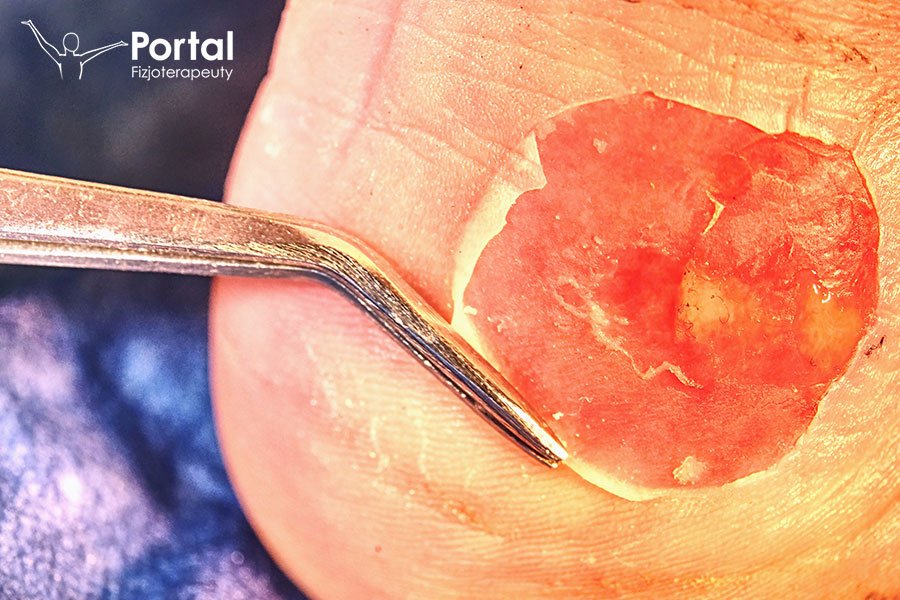 Martwicze zapalenie powięzi