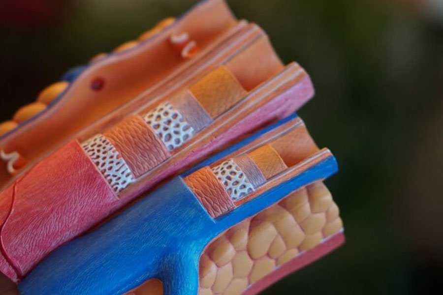 Czy miażdżycę można cofnąć?