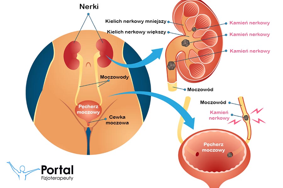 Kamienie nerkowe