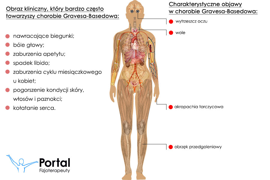 Choroba Gravesa-Basedowa