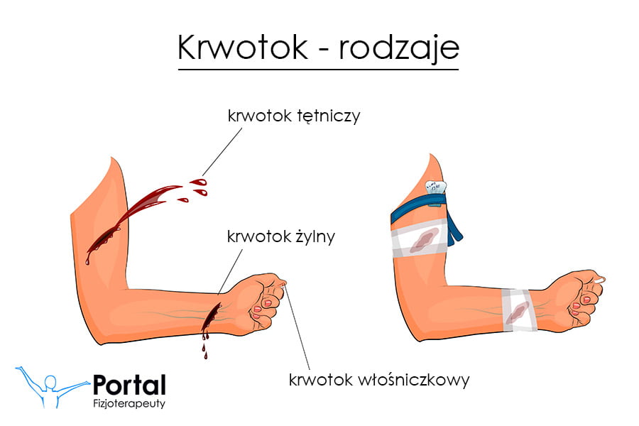Krwotok