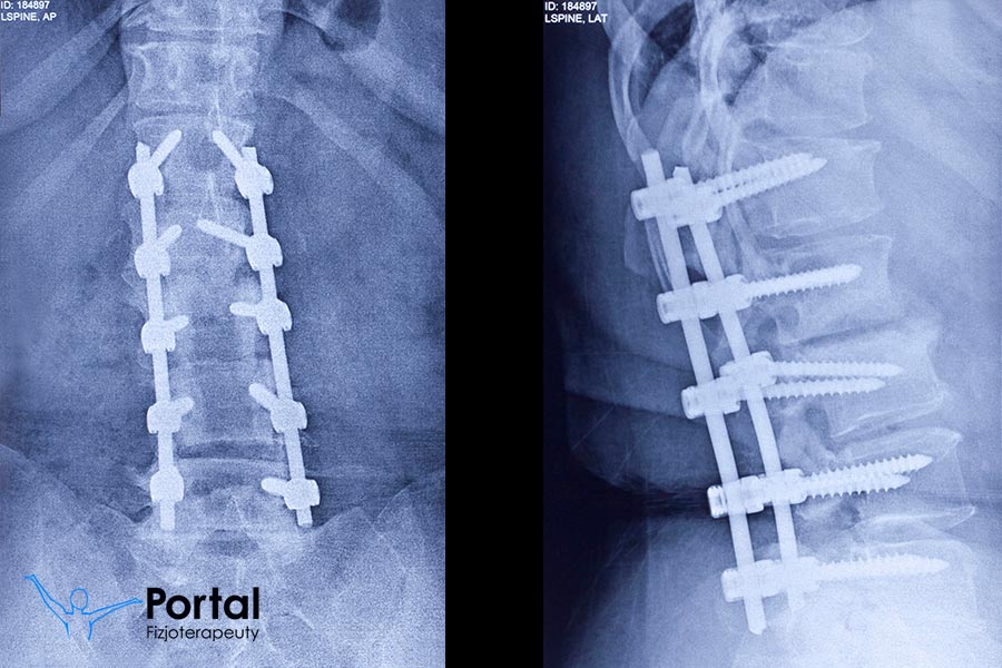 Stabilizacja kręgosłupa