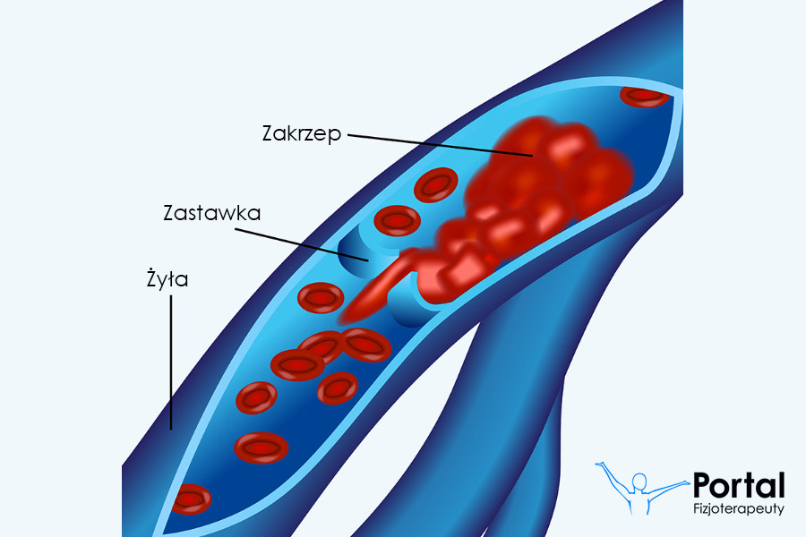 Zakrzepowe zapalenie żył