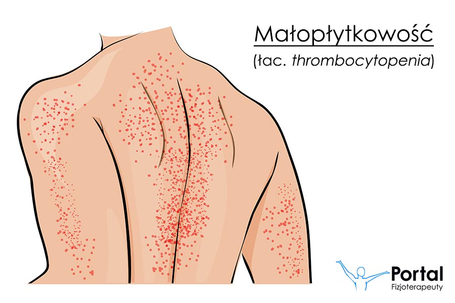 Małopłytkowość (łac. thrombocytopenia)