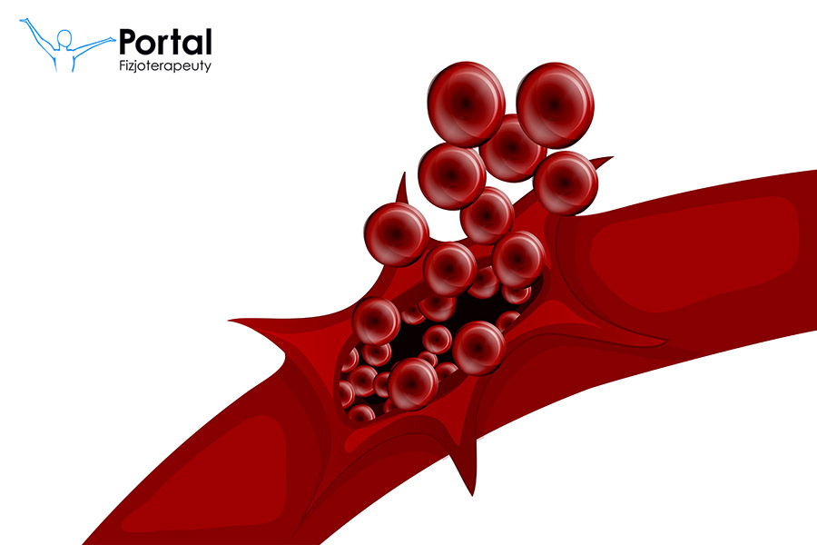 Zaburzenia krzepnięcia krwi