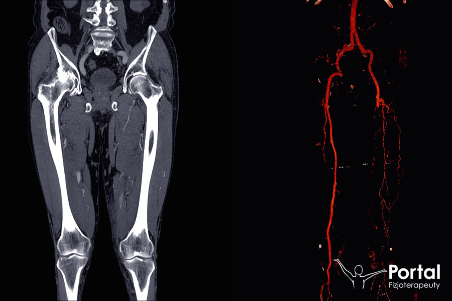 Tętnica udowa (łac. arteria femoralis)