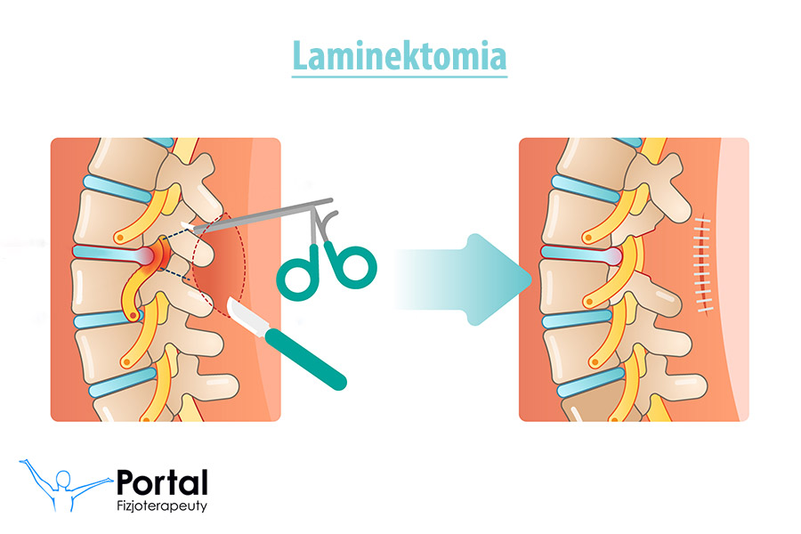 Laminektomia