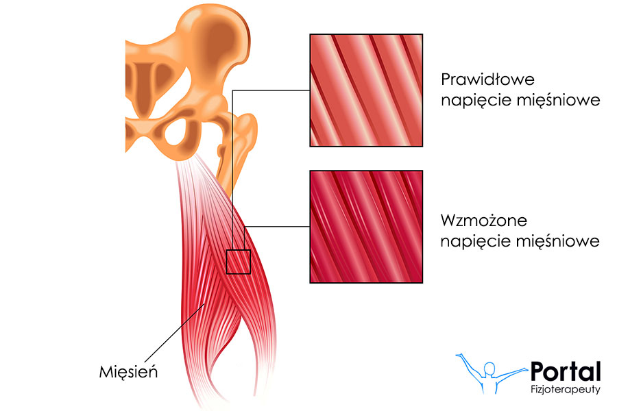 wzmożone napięcie mięśniowe