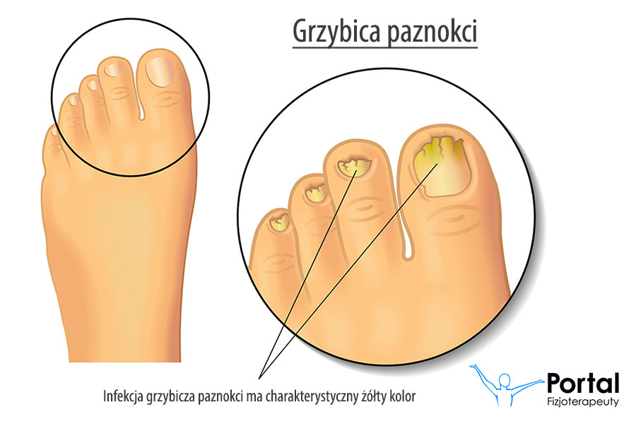 Grzybica paznokci