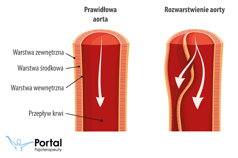 Rozwarstwienie aorty