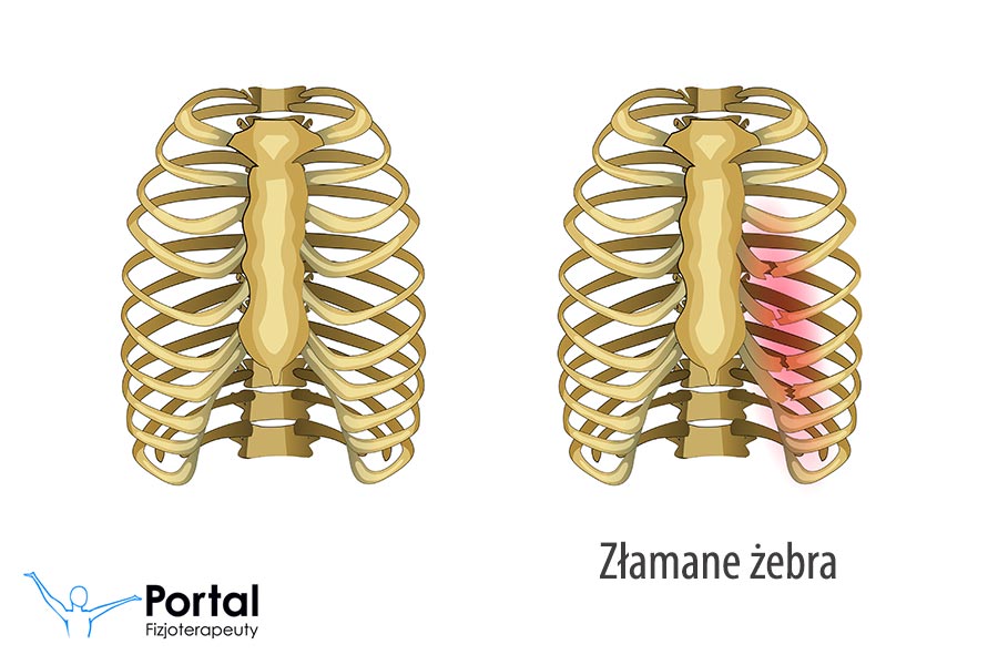Złamane żebro