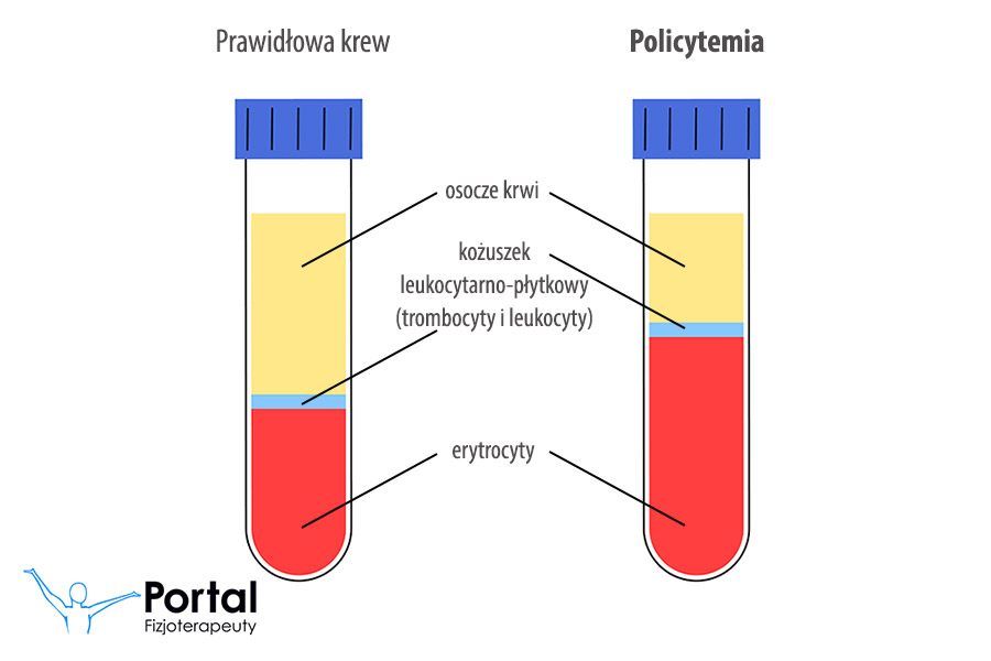 Policytemia