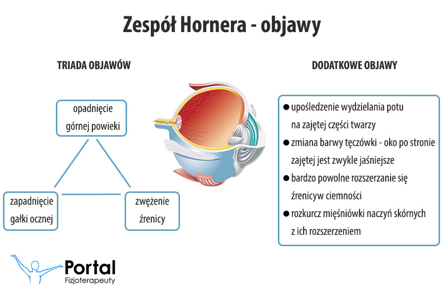 Zespół Hornera