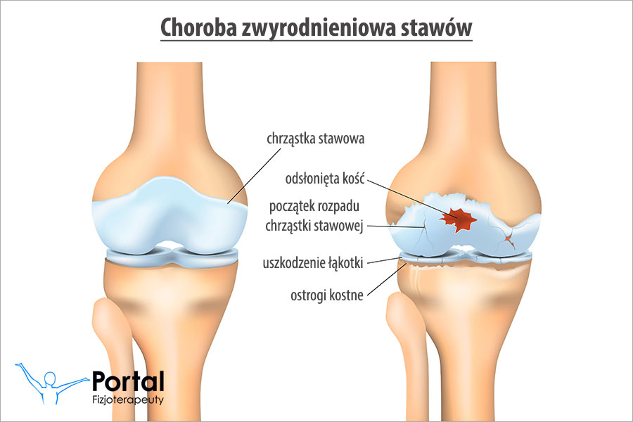 Choroba zwyrodnieniowa stawów