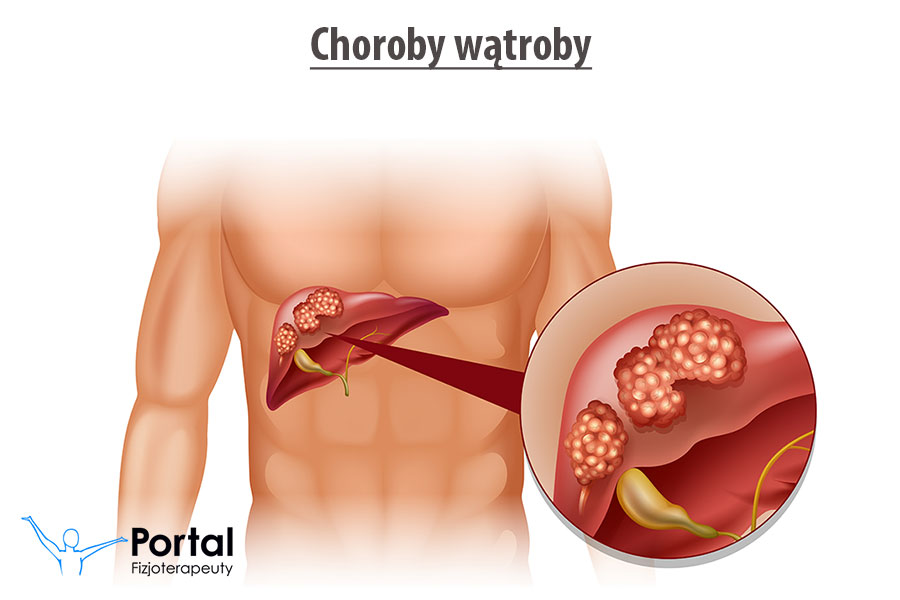 Choroby wątroby