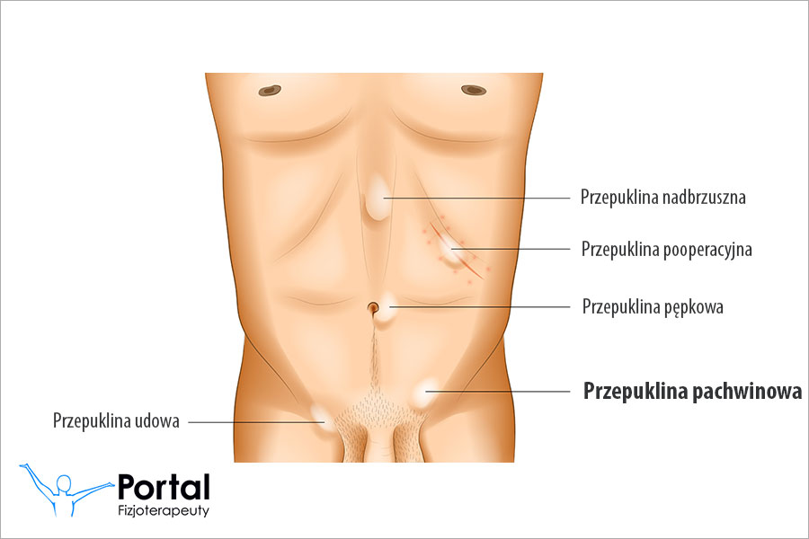 Przepuklina pachwinowa