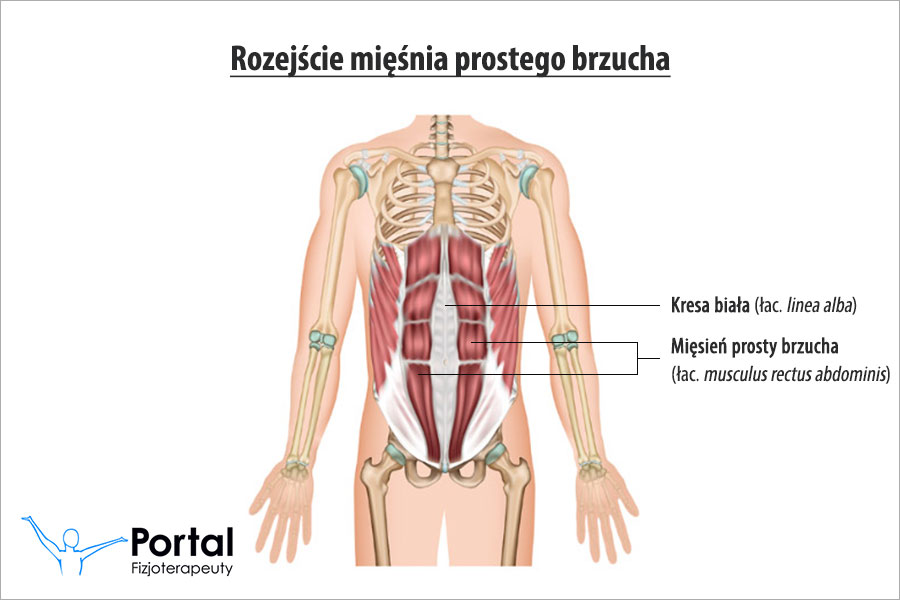 Rozejście mięśnia prostego brzucha
