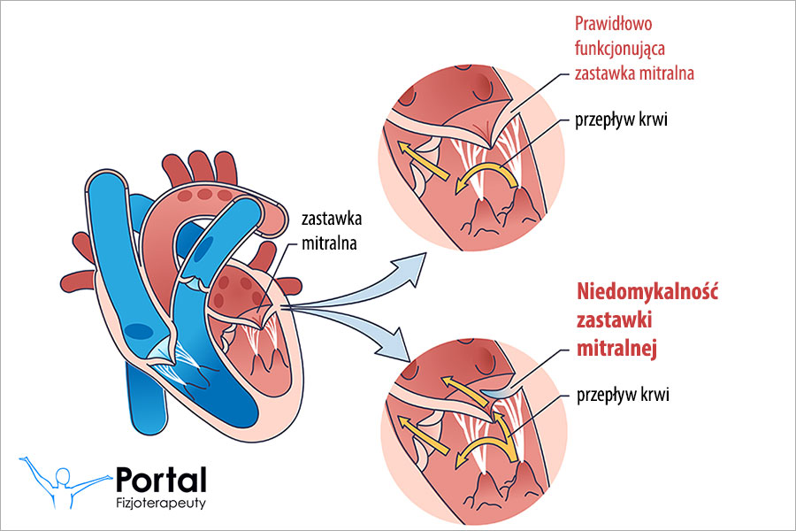 Niedomykalność zastawki mitralnej