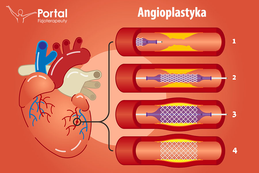 Angioplastyka