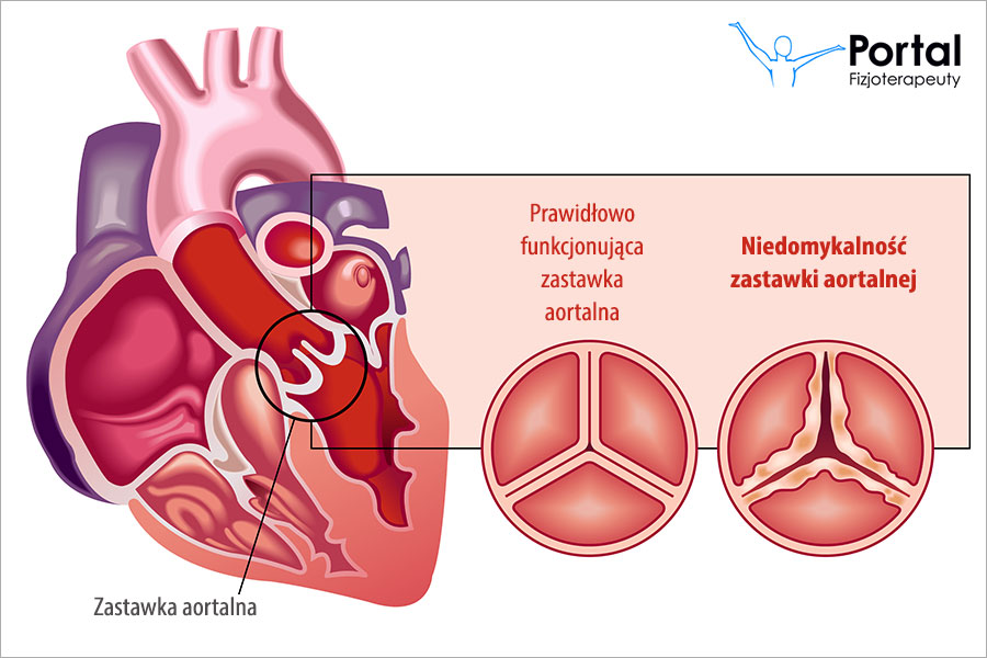 Niedomykalność zastawki aortalnej