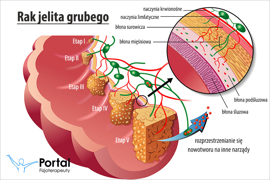 Rak jelita grubego