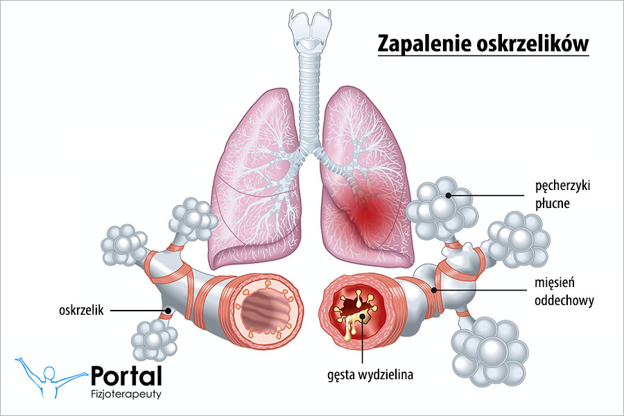 Zapalenie oskrzelików