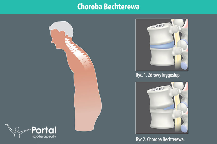 Choroba Bechterewa