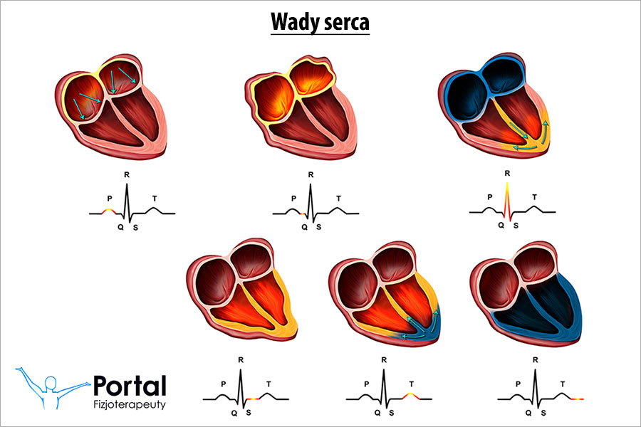 Wady serca