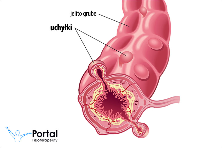 Uchyłki jelita grubego
