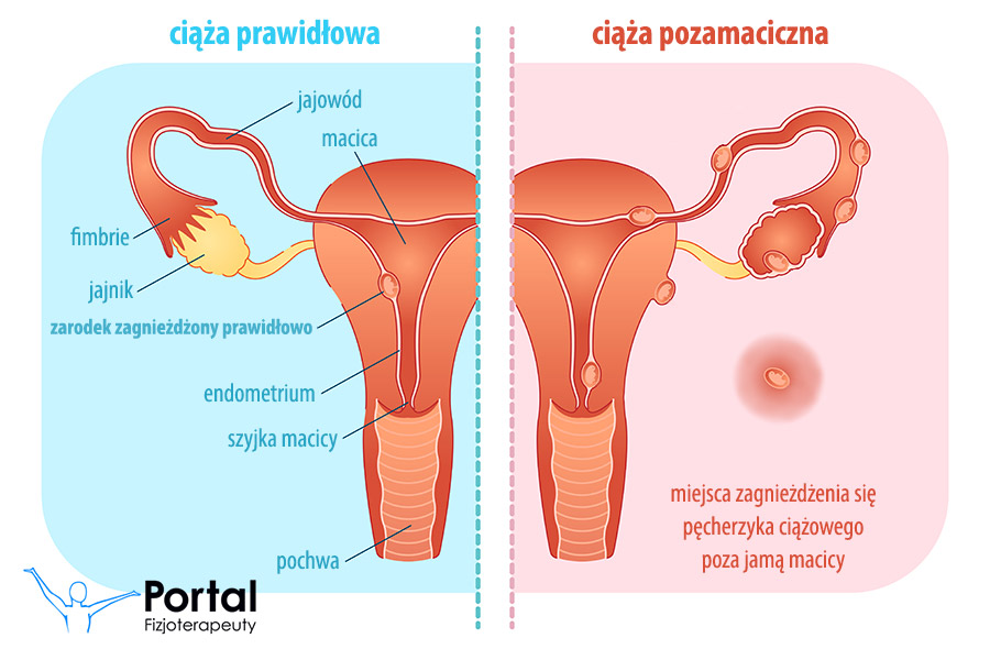 Ciąża pozamaciczna