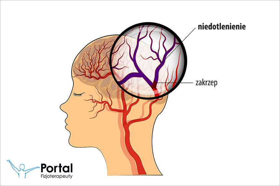 Niedotlenienie mózgu