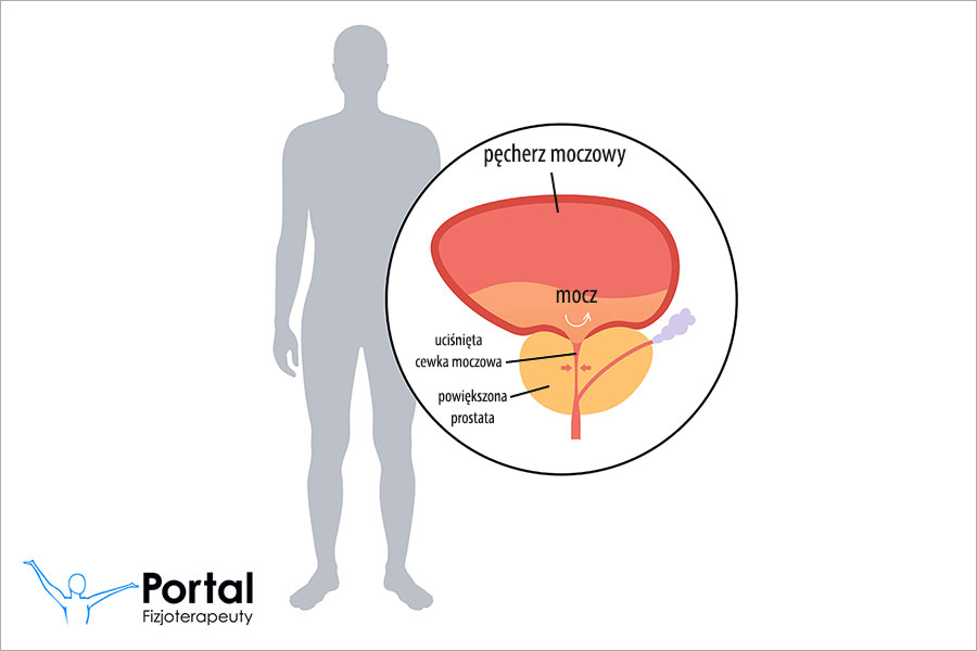Problemy z oddawaniem moczu