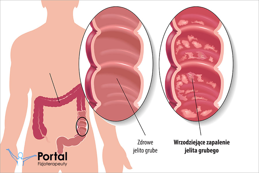 Wrzodziejące zapalenie jelita grubego