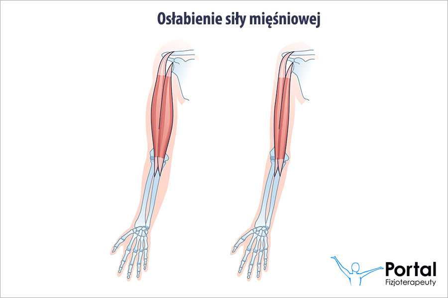 Osłabienie siły mięśniowej