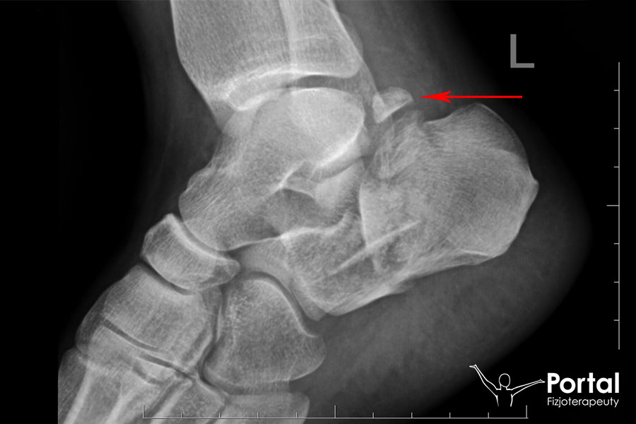 Dodatkowa kostka w stawie skokowym