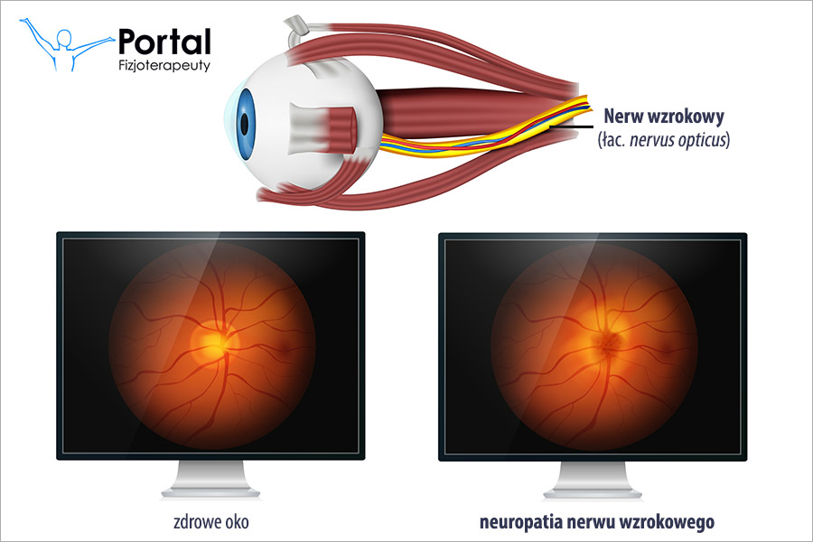 Neuropatia nerwu wzrokowego