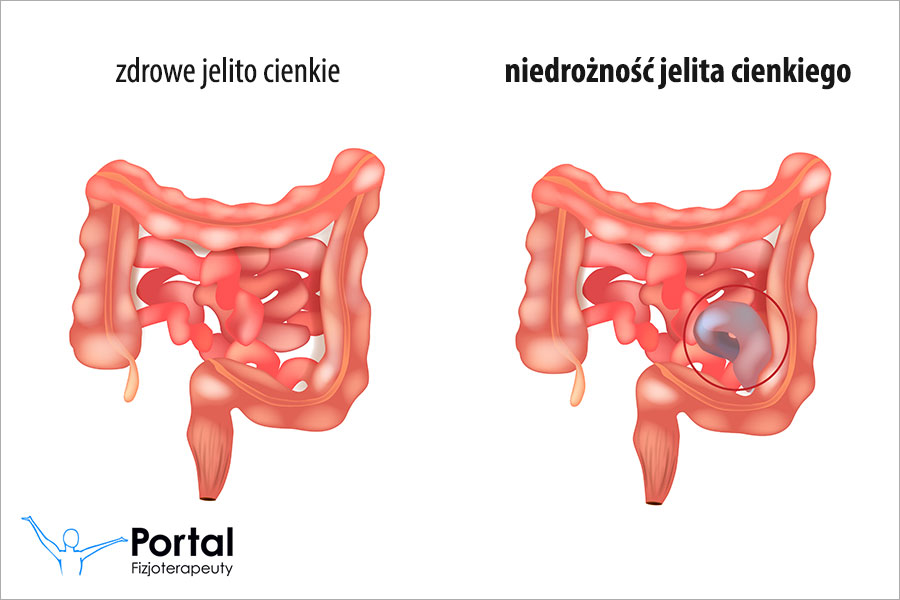 Niedrożność jelita cienkiego