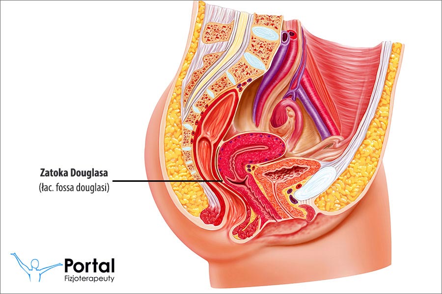 Płyn w zatoce Douglasa