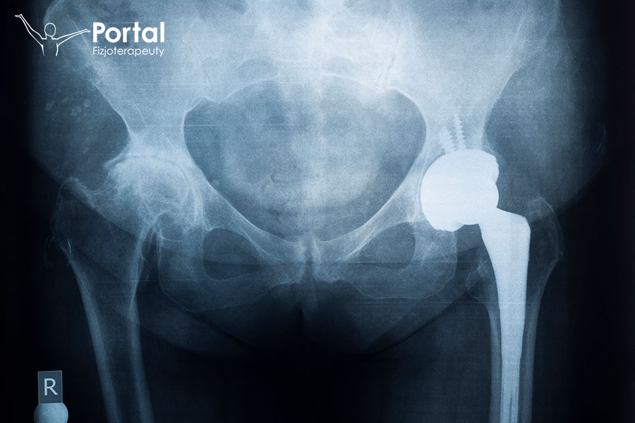 Alloplastyka stawu biodrowego