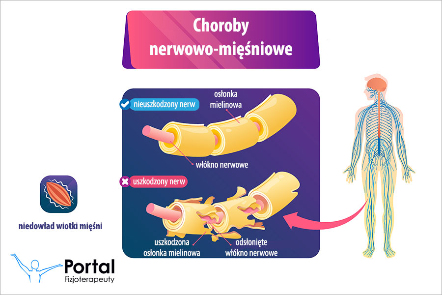 Choroby nerwowo-mięśniowe