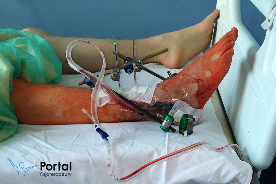 Trudno gojące się rany