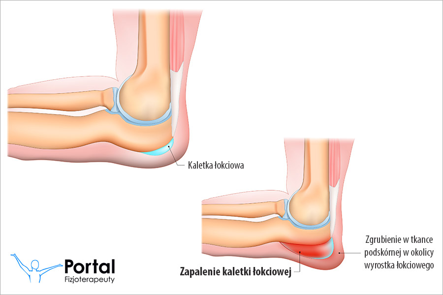 Zapalenie kaletki łokciowej