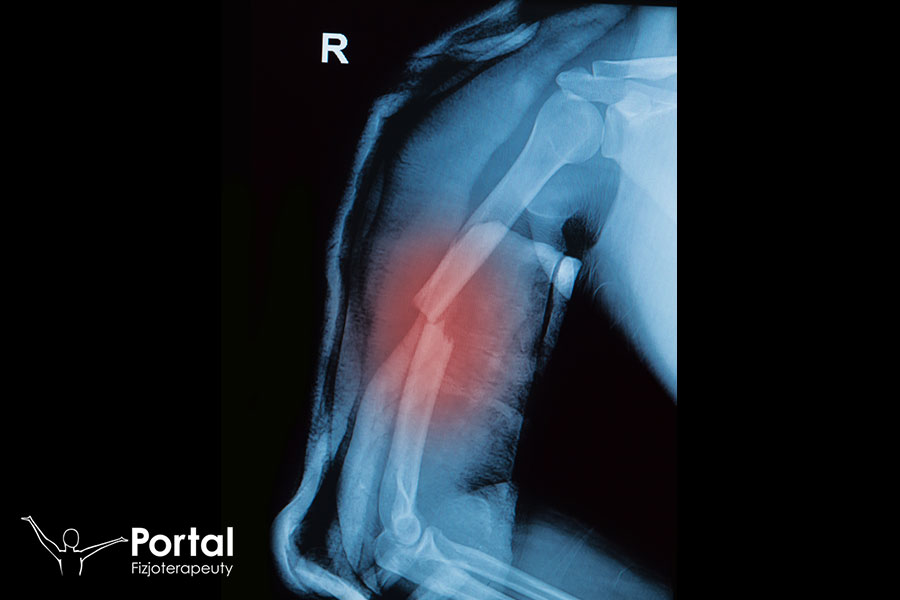 Gips wiszący Caldwella