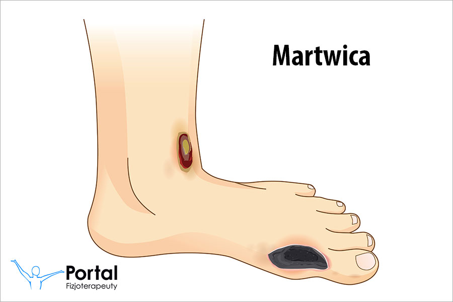 Martwica