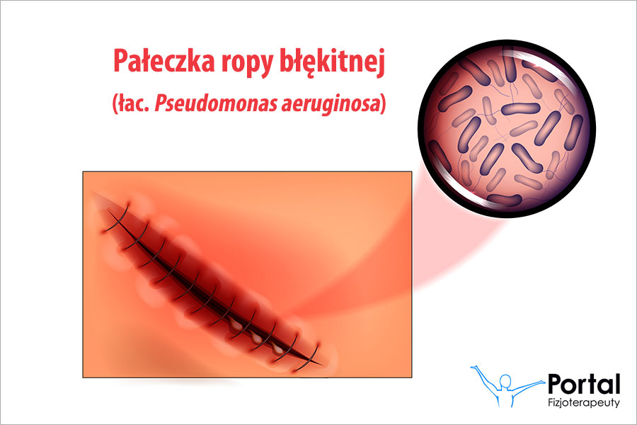 Pałeczka ropy błękitnej (łac. Pseudomonas aeruginosa)